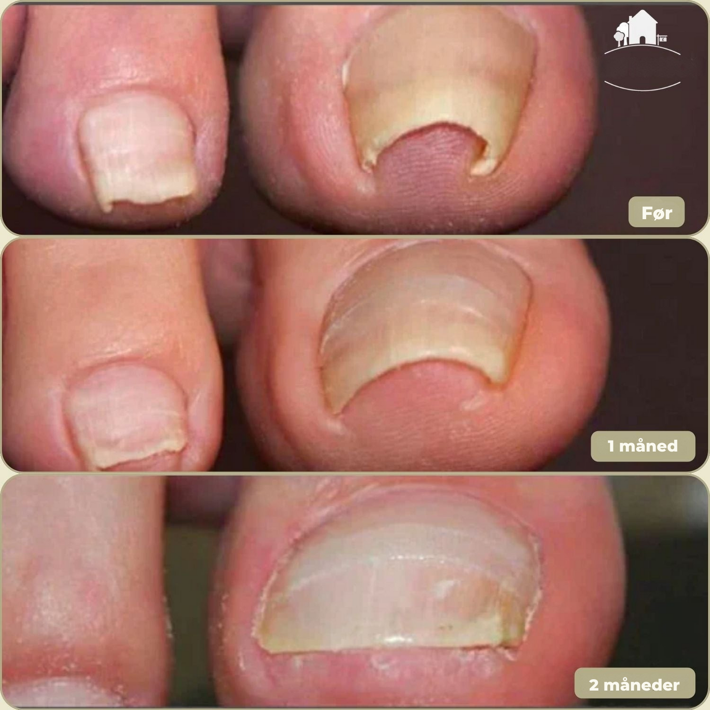 10+10 GRATIS | FixaNail - Sofort Nagelreparation