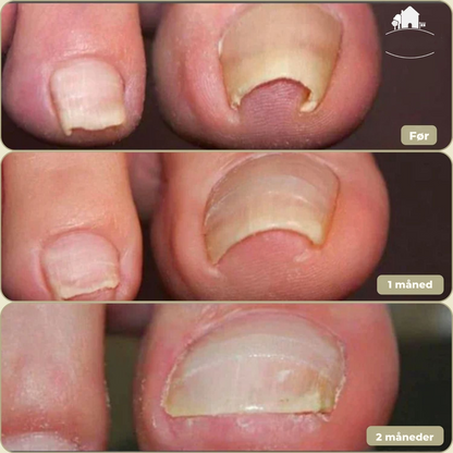 10+10 GRATIS | FixaNail - Sofort Nagelreparation